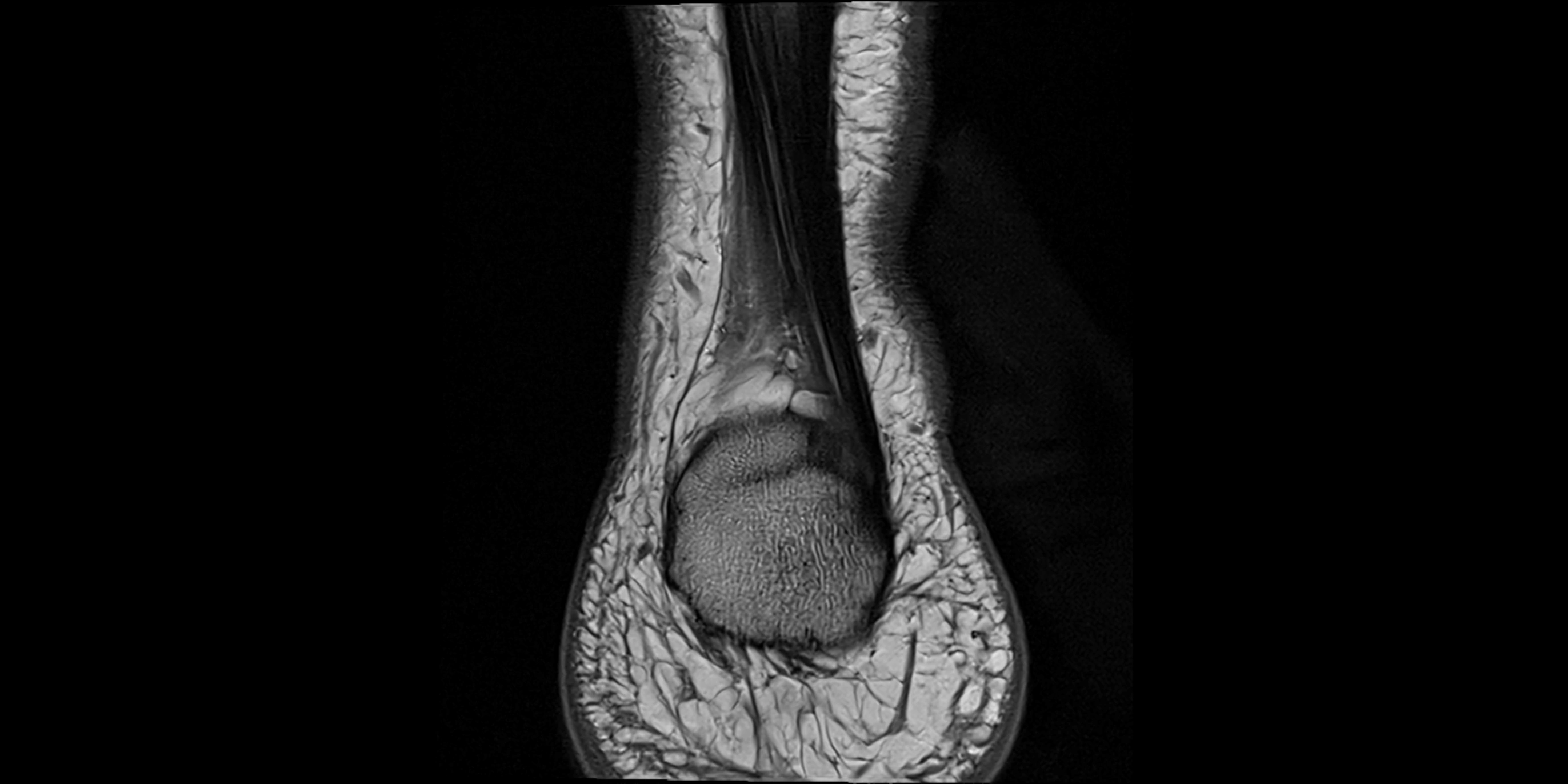 MRI Ankle coronal ligaments cross sectional anatomy 3T  radiology  image-img-00001-00030.webp